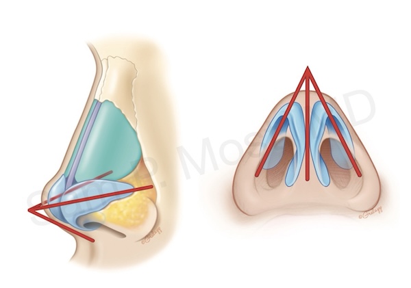 Figure 9-2: Tripod model of nasal tip