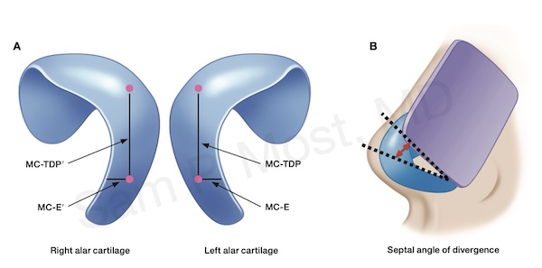 Figure 9-6: Schematic of TIG suture positioning