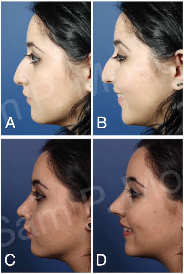 Figure 9-8: Example of patient with improved tip using TIG