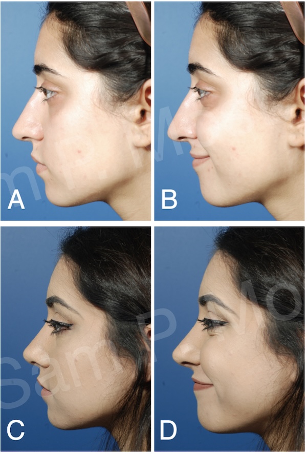 Figure 9-9: TIG used to improve projection and support